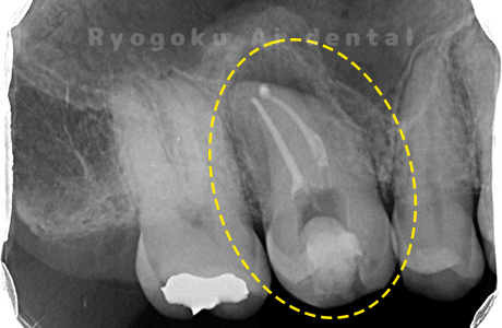 自家歯牙移植術治療術後レントゲン
