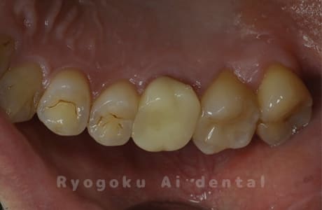 左上６番歯牙破折