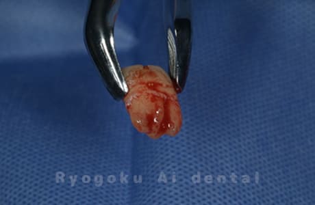 自家歯牙移植の親知らず