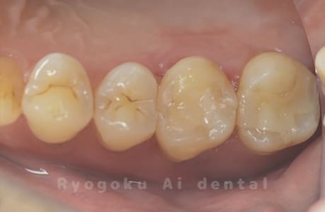 自家歯牙移植術治療完了