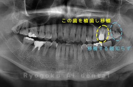 左上６番歯牙破折レントゲン