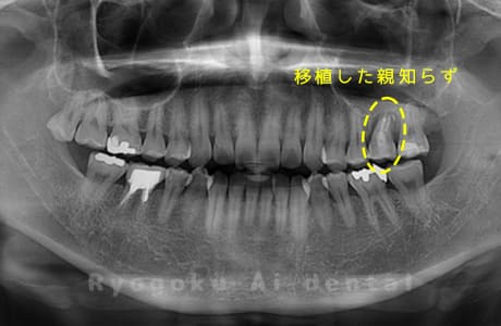 自家歯牙移植術治療術後レントゲン