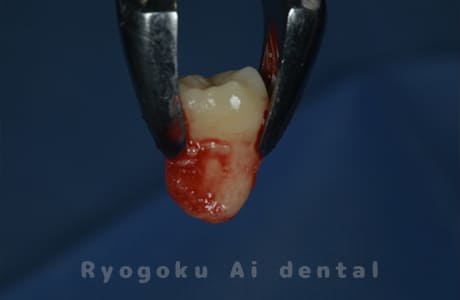 自家歯牙移植の親知らず