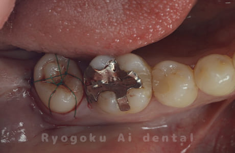 自家歯牙移植術後