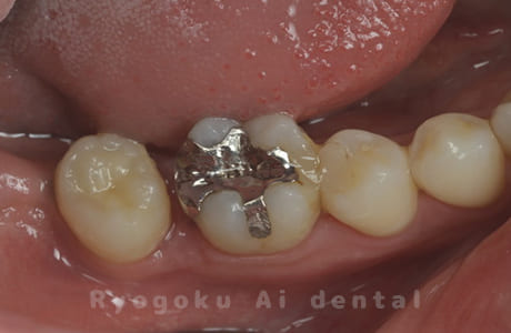 自家歯牙移植術治療完了