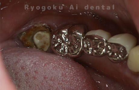 右下7番重度カリエス