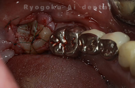 自家歯牙移植の親知らず