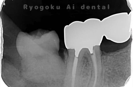 右下7番重度カリエスレントゲン