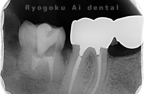 自家歯牙移植の親知らずレントゲン