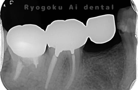 自家歯牙移植術後レントゲン