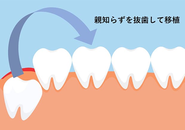 自家歯牙移植とは