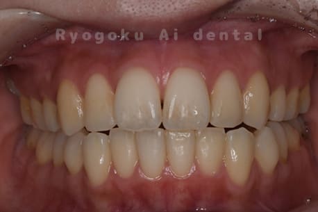 ホワイトニング術前