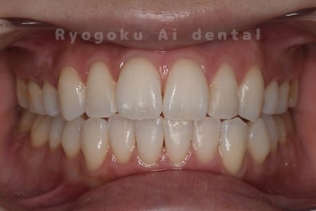 デュアルホワイトニング術後