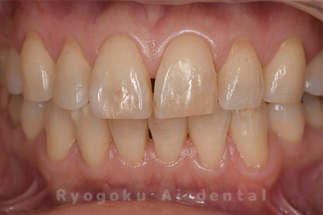 デュアルホワイトニング