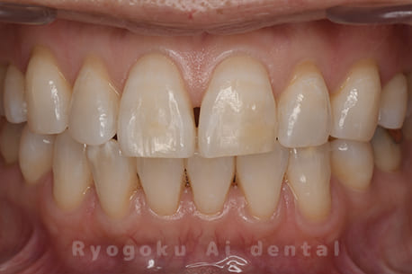 オフィスホワイトニング1回、ホームホワイトニング1回