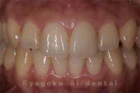 デュアルホワイトニング