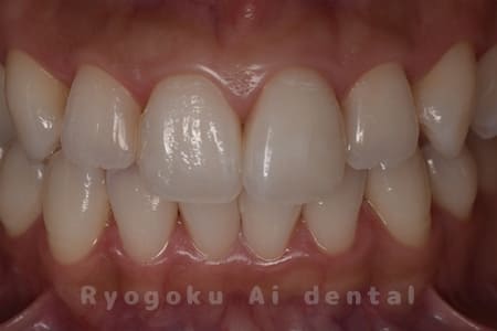 2時間+10日間既製トレー法