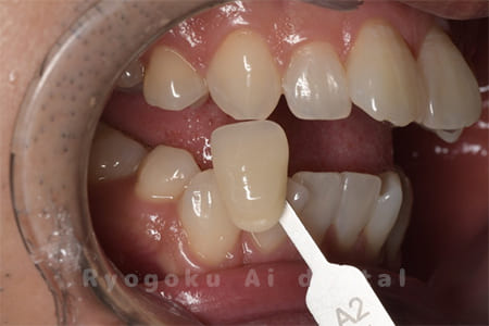 オフィスホワイトニング＋ホームホワイトニング術前