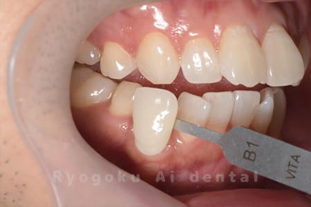 オフィスホワイトニング＋ホームホワイトニング術後