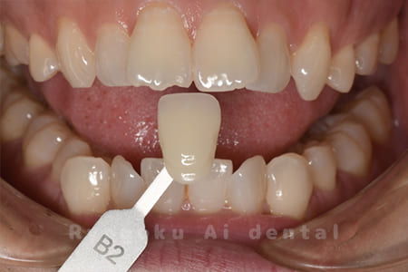 オフィスホワイトニング＋ホームホワイトニング色調合わせ術前