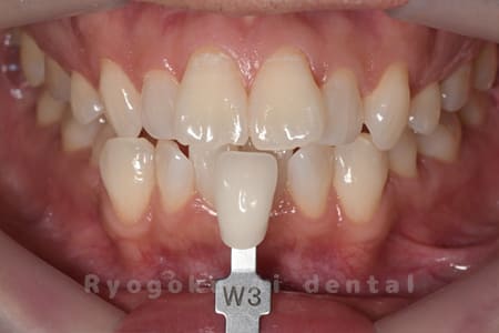 オフィスホワイトニング＋ホームホワイトニング色調合わせ術後