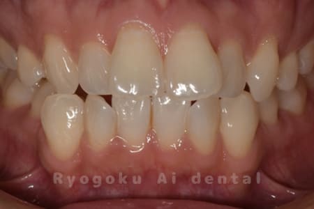 オフィスホワイトニング＋ホームホワイトニング正面観術前