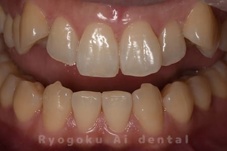 オフィスホワイトニング、ホームホワイトニング術前