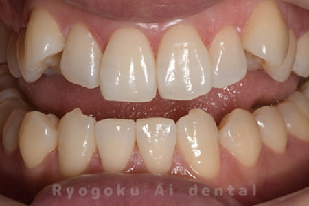 オフィスホワイトニング、ホームホワイトニング術後