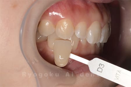 ホームホワイトニング術前