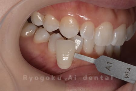 ホームホワイトニング術後