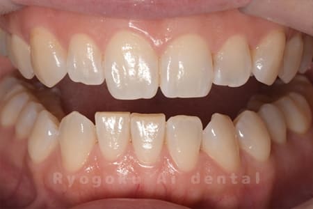 ホームホワイトニング術前