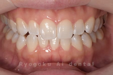 ホームホワイトニング術後