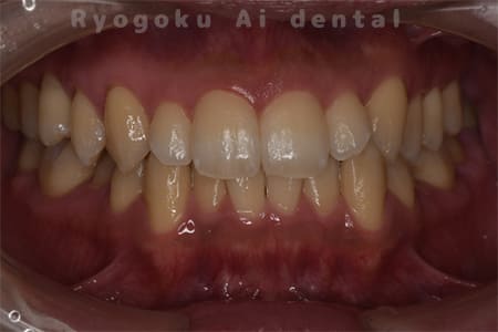 オフィスホワイトニング術前