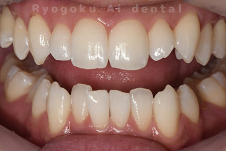 オフィスホワイトニング術後