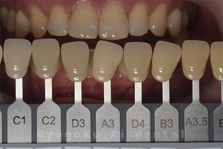 オフィスホワイトニング、ホームホワイトニング色調合わせ術前