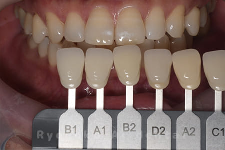 オフィスホワイトニング、ホームホワイトニング色調合わせ術後