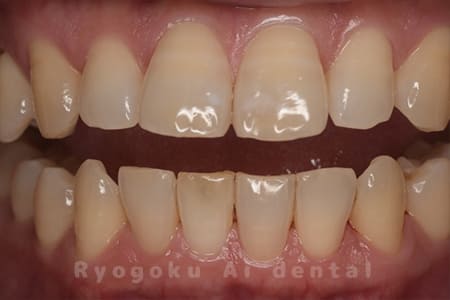 オフィスホワイトニング、ホームホワイトニング術前