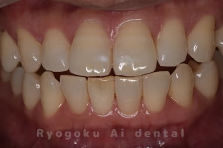 オフィスホワイトニング、ホームホワイトニング術後