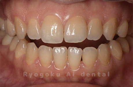 オフィスホワイトニング術前