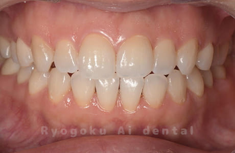 オフィスホワイトニング術後