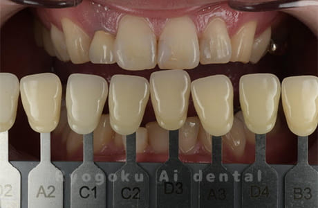 ホームホワイトニング色調合わせ術前