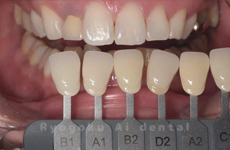 ホームホワイトニング色調合わせ術後