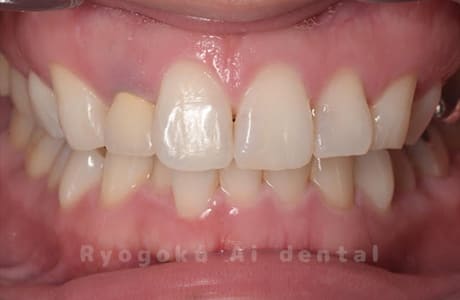 ホームホワイトニング術後