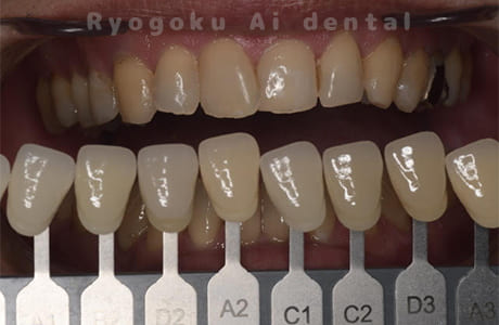 オフィスホワイトニング＆ホームホワイトニング術前