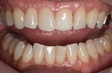 オフィスホワイトニング＆ホームホワイトニング術後