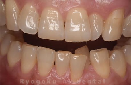 オフィスホワイトニング術前