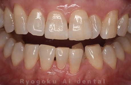 オフィスホワイトニング術後