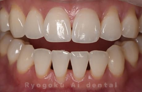 オフィスホワイトニング＆ホームホワイトニング術後