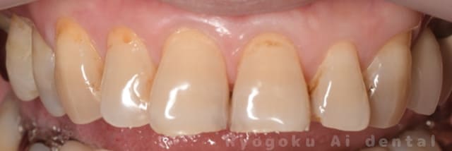 オフィスホワイトニング＆ホームホワイトニング術前