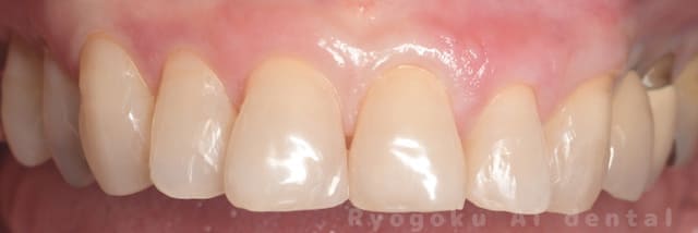 オフィスホワイトニング＆ホームホワイトニング術後